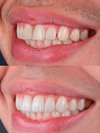 Facetas de Porcelana
