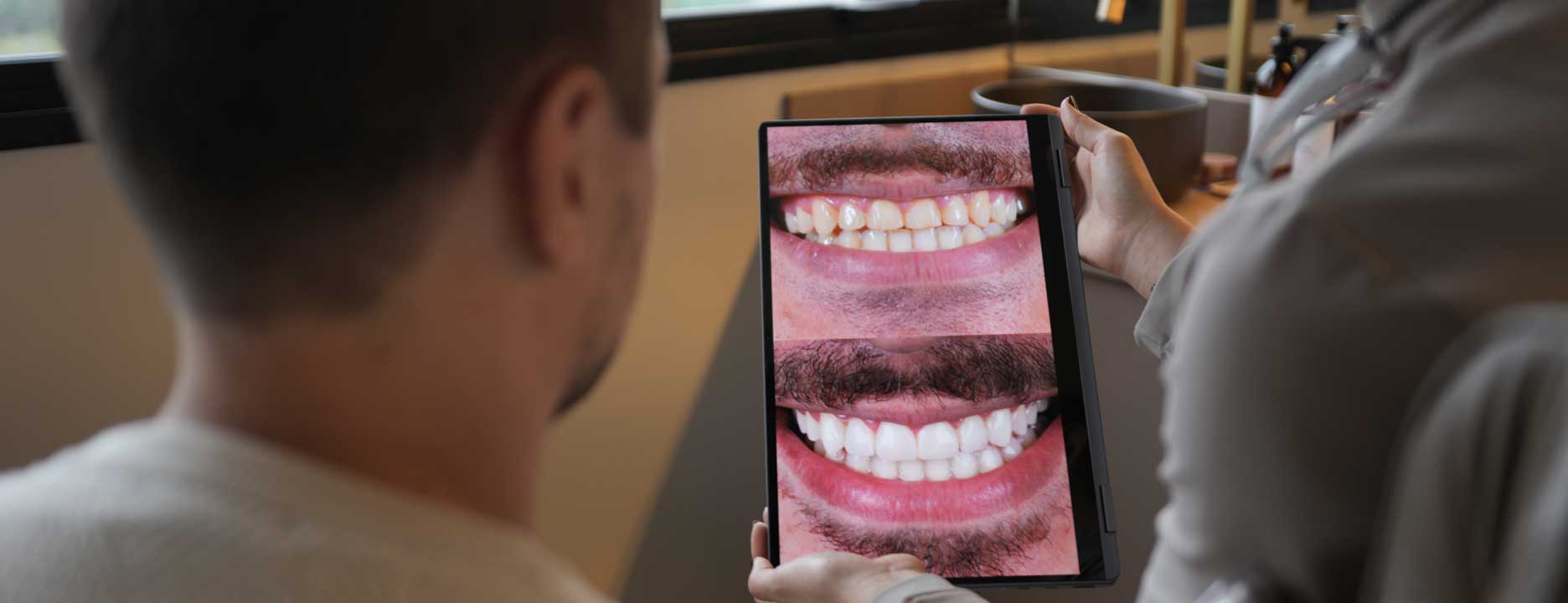 facetas de resina composta antes e depois